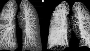 Así lucen los pulmones de personas con Coronavirus a través de los rayos X