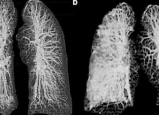 Cinco hospitales de la SSM, con mayor ocupación en atención por enfermedades respiratorias graves Así lucen los pulmones de personas con Coronavirus a través de los rayos X