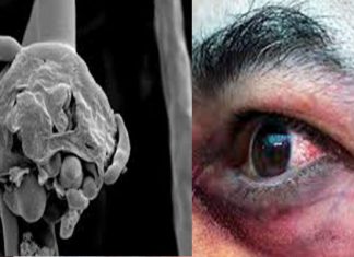 Detectan primer caso de Hongo Negro en México