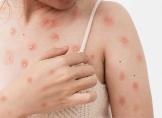 Mantiene SSM vigilancia para la detección y atención de la viruela del mono