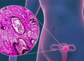 Realízate el Papanicolau de forma gratuita en Michoacán para prevenir