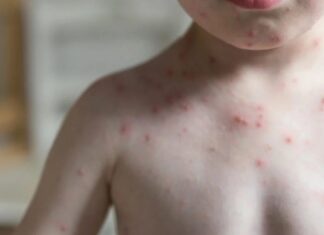 Confirman primeros casos de sarampión en Michoacán; activan cerco sanitario en Maravatío